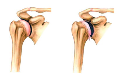 Унковертебральный артроз плечевого сустава thumbnail