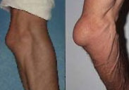 Бурсит коленного сустава - симптомы и лечение thumbnail
